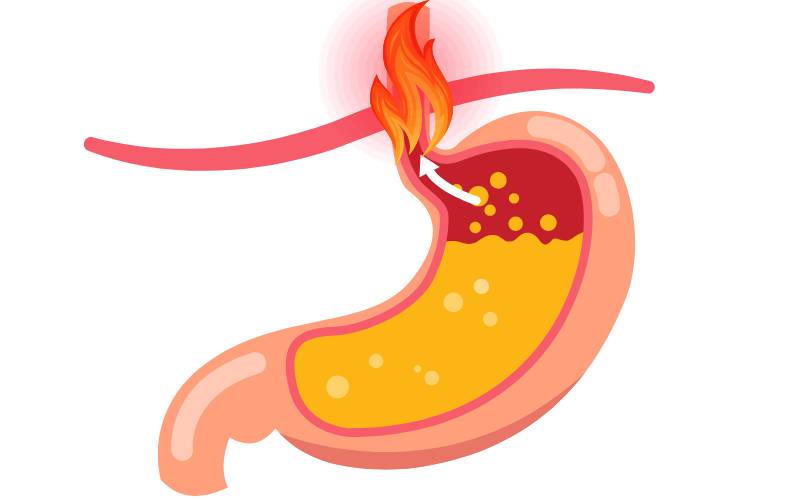 Reflusso Gastroesofageo Reflusso Gastroesofageo, grafica stilizzata che indica lo stomaco e il reflusso acido che risale causando sofferenza all'esofago